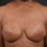 Immediate Breast Reconstruction -  Skin Sparring - Case #45 After
