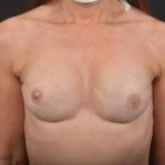Immediate Breast Reconstruction - Nipple Sparring - Case #43 After