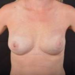 Immediate Breast Reconstruction - Nipple Sparring - Case #42 After
