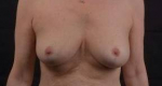 Mastopexy - Case #26 After