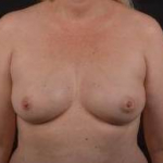 Immediate Breast Reconstruction - Nipple Sparring - Case #38 Before