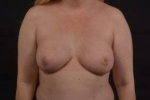 Immediate Breast Reconstruction - Nipple Sparring - Case #38 After
