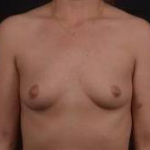 Immediate Breast Reconstruction - Nipple Sparring - Case #37 Before