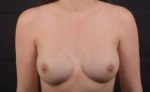 Immediate Breast Reconstruction - Nipple Sparring - Case #36 After