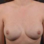 Immediate Breast Reconstruction - Nipple Sparring - Case #36 After