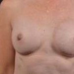 Immediate Breast Reconstruction - Nipple Sparring - Case #26 After