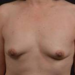 Immediate Breast Reconstruction - Nipple Sparring - Case #47 Before