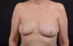 Immediate Breast Reconstruction - Nipple Sparring - Case #46 Before