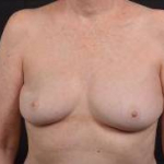 Immediate Breast Reconstruction - Nipple Sparring - Case #46 Before