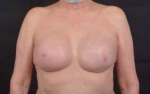 Immediate Breast Reconstruction - Nipple Sparring - Case #46 After