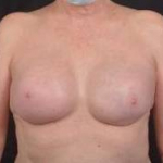 Immediate Breast Reconstruction - Nipple Sparring - Case #46 After