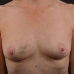 Immediate Breast Reconstruction - Nipple Sparring - Case #34 Before