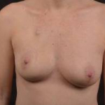 Immediate Breast Reconstruction - Nipple Sparring - Case #33 Before