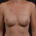 Immediate Breast Reconstruction - Nipple Sparring - Case #33 After