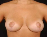 Mastopexy - Case #9 After