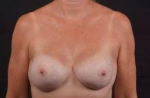 Immediate Breast Reconstruction - Nipple Sparring - Case #31 After
