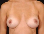 Mastopexy - Case #10 After