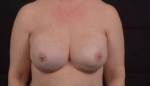 Immediate Breast Reconstruction - Nipple Sparring - Case #30 After
