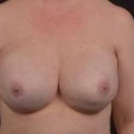 Immediate Breast Reconstruction - Nipple Sparring - Case #30 After