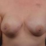 Immediate Breast Reconstruction - Nipple Sparring - Case #28 After