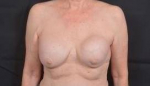 Breast Augmentation Mastopexy Revision - Case #55 Before