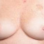 Immediate Breast Reconstruction - Nipple Sparring - Case #25 Before