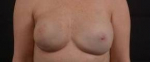 Immediate Breast Reconstruction - Nipple Sparring - Case #25 After