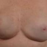 Immediate Breast Reconstruction - Nipple Sparring - Case #25 After
