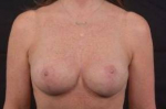 Breast Augmentation Mastopexy Revision - Case #48 After