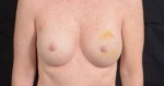 Immediate Breast Reconstruction - Nipple Sparring - Case #24 Before