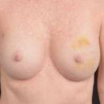 Immediate Breast Reconstruction - Nipple Sparring - Case #24 Before