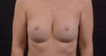 Immediate Breast Reconstruction - Nipple Sparring - Case #24 After