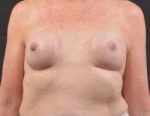 Immediate Breast Reconstruction - Nipple Sparring - Case #23 Before