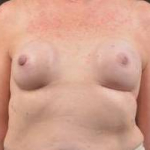 Immediate Breast Reconstruction - Nipple Sparring - Case #23 Before