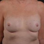 Immediate Breast Reconstruction - Nipple Sparring - Case #23 After