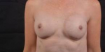 Immediate Breast Reconstruction - Nipple Sparring - Case #20 After