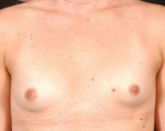 Immediate Breast Reconstruction - Nipple Sparing - Case #1 Before