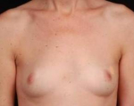 Immediate Breast Reconstruction - Nipple Sparing - Case #2 Before