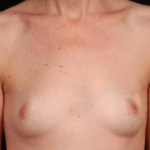 Immediate Breast Reconstruction - Nipple Sparing - Case #2 Before