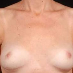 Immediate Breast Reconstruction - Nipple Sparing - Case #2 After