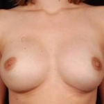 Immediate Breast Reconstruction - Nipple Sparing - Case #3 After