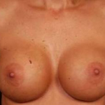 Immediate Breast Reconstruction - Nipple Sparing - Case #4 Before