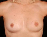 Immediate Breast Reconstruction - Nipple Sparing - Case #5 Before