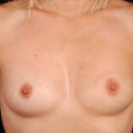 Immediate Breast Reconstruction - Nipple Sparing - Case #5 Before