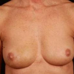 Immediate Breast Reconstruction - Nipple Sparing - Case #6 Before