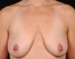 Immediate Breast Reconstruction - Nipple Sparing - Case #7 Before