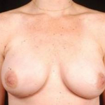 Immediate Breast Reconstruction - Nipple Sparing - Case #7 After