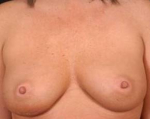 Immediate Breast Reconstruction - Nipple Sparing - Case #8 Before
