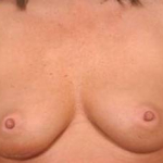 Immediate Breast Reconstruction - Nipple Sparing - Case #8 Before
