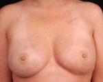 Immediate Breast Reconstruction - Nipple Sparing - Case #8 After